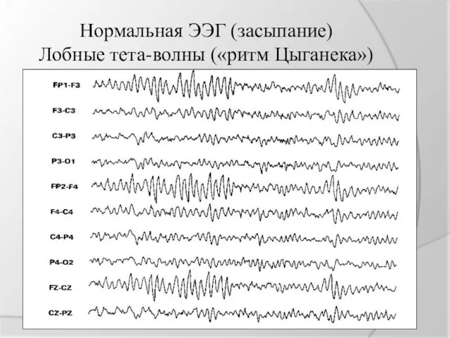 Нормальная ЭЭГ (засыпание) Лобные тета-волны («ритм Цыганека»)