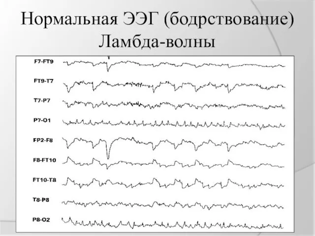 Нормальная ЭЭГ (бодрствование) Ламбда-волны