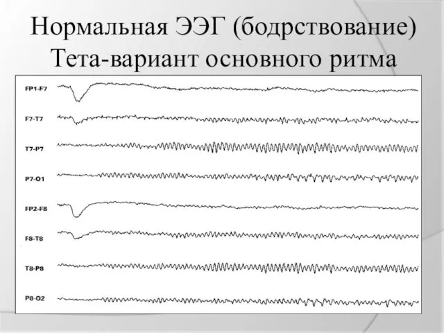 Нормальная ЭЭГ (бодрствование) Тета-вариант основного ритма