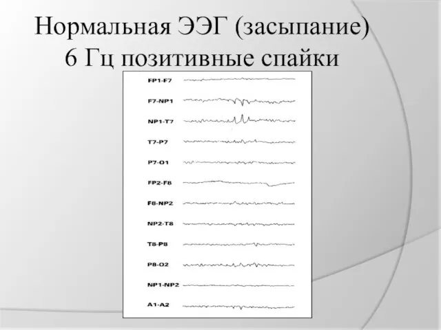 Нормальная ЭЭГ (засыпание) 6 Гц позитивные спайки