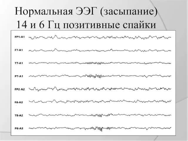 Нормальная ЭЭГ (засыпание) 14 и 6 Гц позитивные спайки