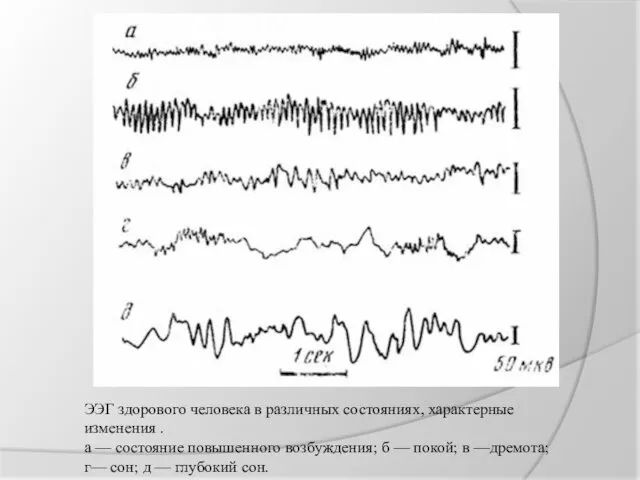 ЭЭГ здорового человека в различных состояниях, характерные изменения . а