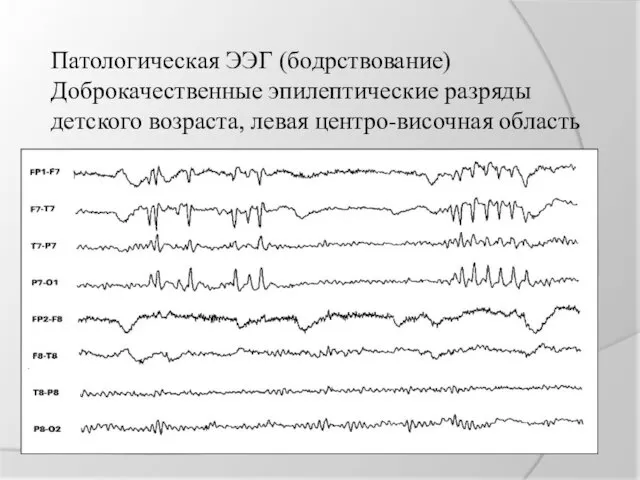 Патологическая ЭЭГ (бодрствование) Доброкачественные эпилептические разряды детского возраста, левая центро-височная область