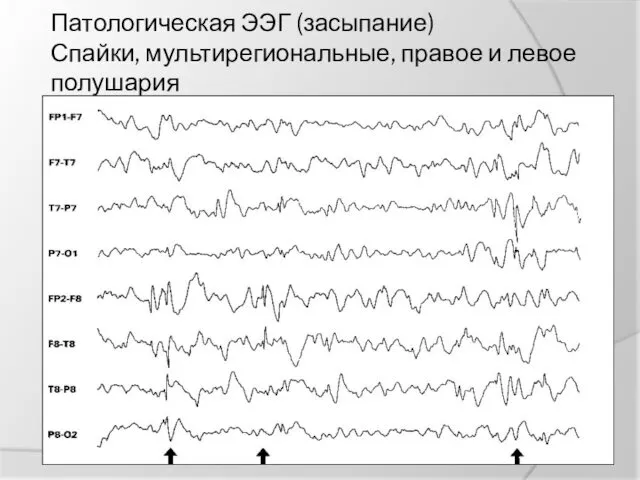 Патологическая ЭЭГ (засыпание) Спайки, мультирегиональные, правое и левое полушария