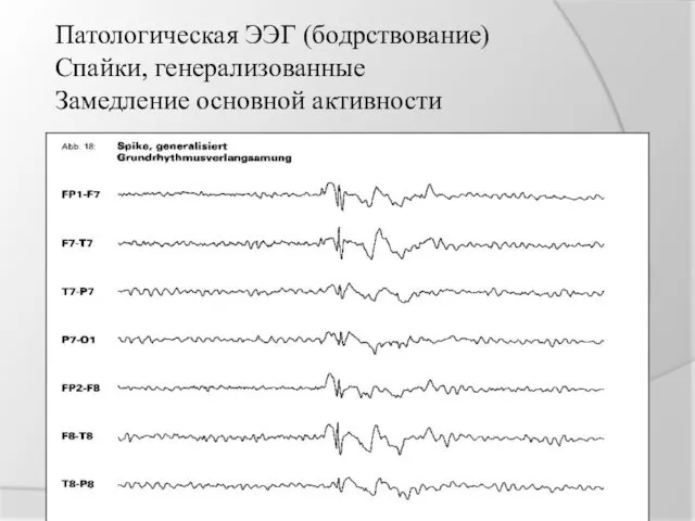 Патологическая ЭЭГ (бодрствование) Спайки, генерализованные Замедление основной активности