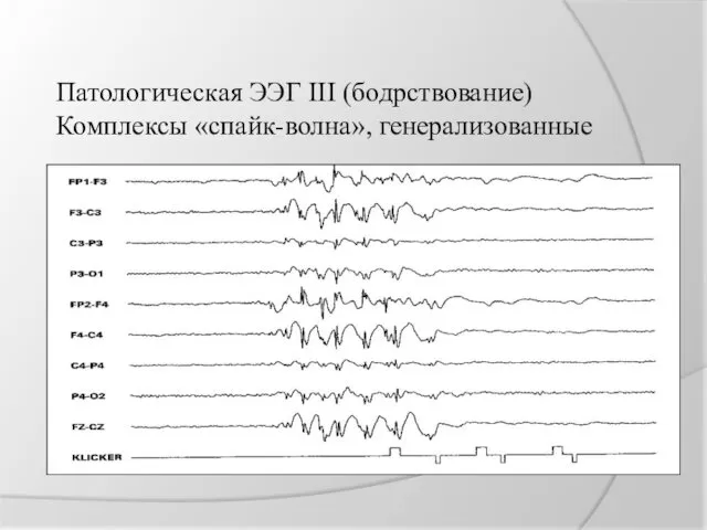 Патологическая ЭЭГ III (бодрствование) Комплексы «спайк-волна», генерализованные