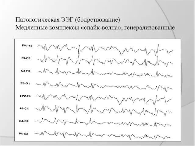 Патологическая ЭЭГ (бодрствование) Медленные комплексы «спайк-волна», генерализованные