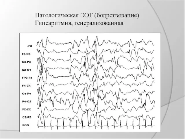 Патологическая ЭЭГ (бодрствование) Гипсаритмия, генерализованная