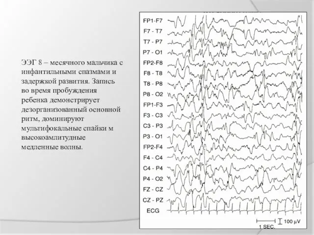 ЭЭГ 8 – месячного мальчика с инфантильными спазмами и задержкой