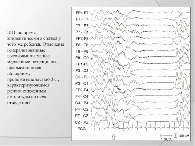 ЭЭГ во время эпилептического спазма у того же ребенка. Отмечены