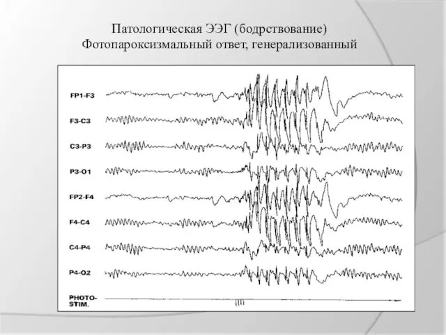 Патологическая ЭЭГ (бодрствование) Фотопароксизмальный ответ, генерализованный