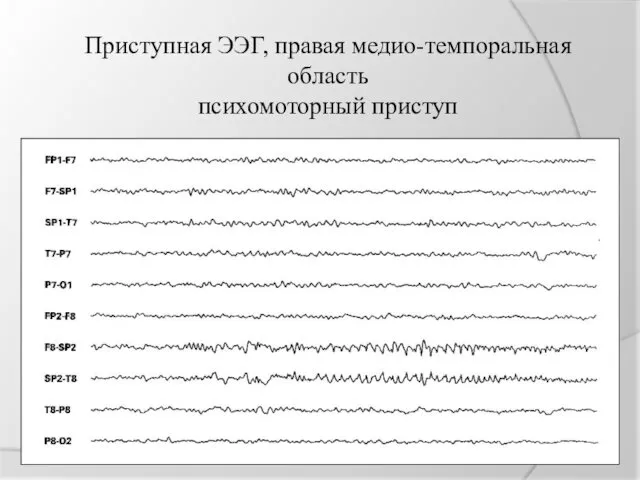 Приступная ЭЭГ, правая медио-темпоральная область психомоторный приступ