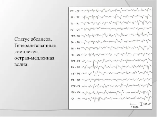 Статус абсансов. Генерализованные комплексы острая-медленная волна.