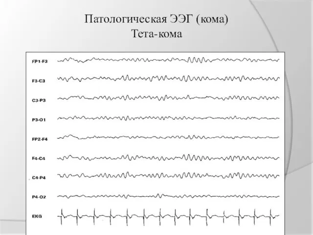 Патологическая ЭЭГ (кома) Тета-кома