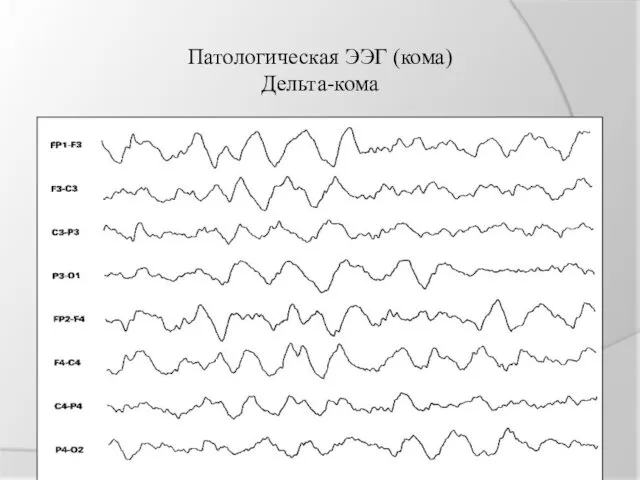 Патологическая ЭЭГ (кома) Дельта-кома