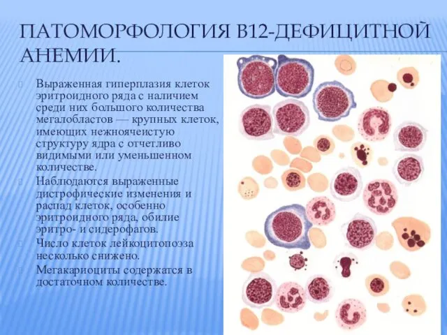 ПАТОМОРФОЛОГИЯ В12-ДЕФИЦИТНОЙ АНЕМИИ. Выраженная гиперплазия клеток эритроидного ряда с наличием