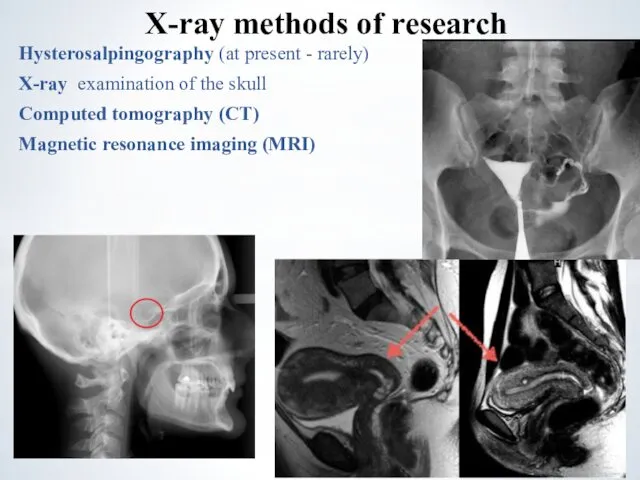 Hysterosalpingography (at present - rarely) X-ray examination of the skull