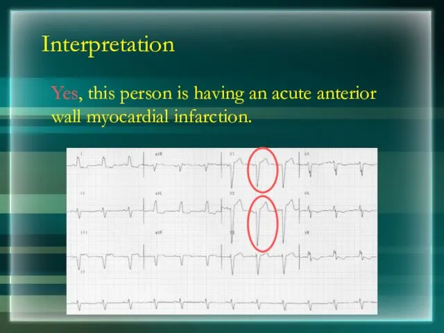 Interpretation Yes, this person is having an acute anterior wall myocardial infarction.