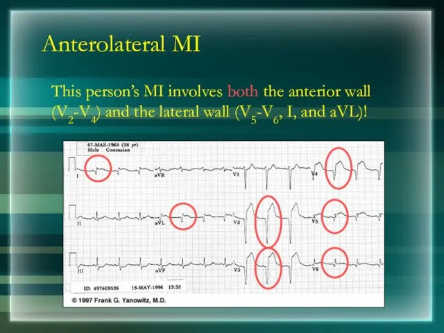 Anterolateral MI This person’s MI involves both the anterior wall (V2-V4) and the