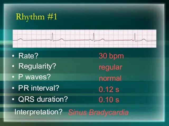 Rhythm #1 30 bpm Rate? Regularity? regular normal 0.10 s P waves? PR