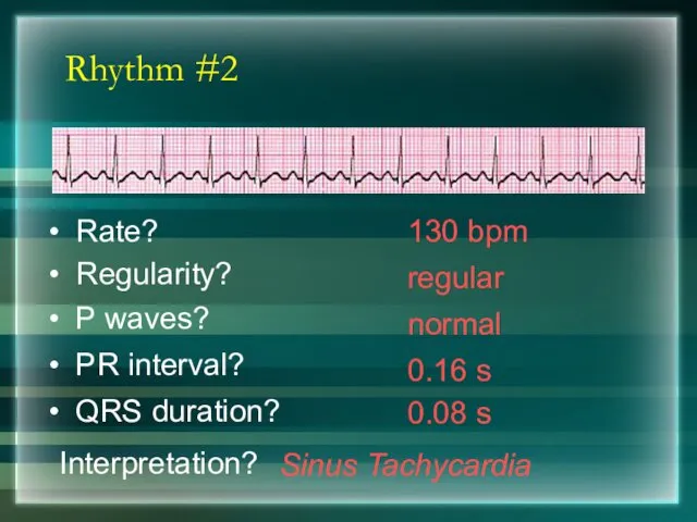 Rhythm #2 130 bpm Rate? Regularity? regular normal 0.08 s