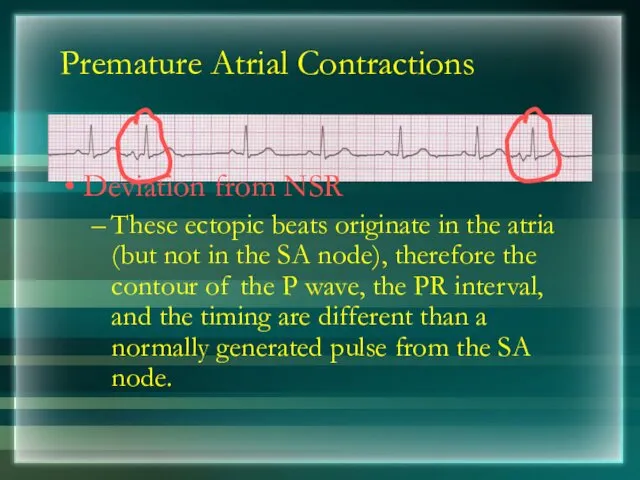 Premature Atrial Contractions Deviation from NSR These ectopic beats originate in the atria