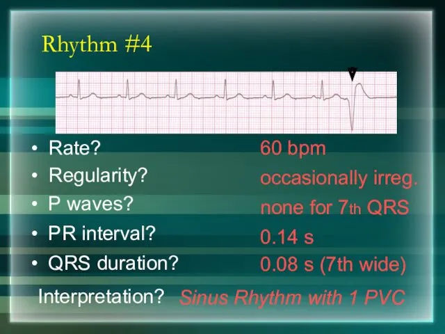 Rhythm #4 60 bpm Rate? Regularity? occasionally irreg. none for 7th QRS 0.08