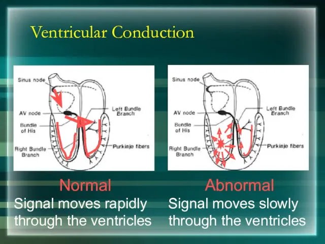 Ventricular Conduction Normal Signal moves rapidly through the ventricles Abnormal Signal moves slowly through the ventricles