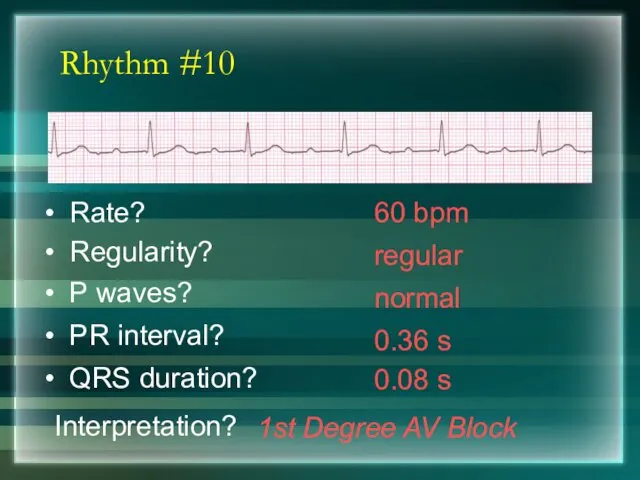 Rhythm #10 60 bpm Rate? Regularity? regular normal 0.08 s P waves? PR