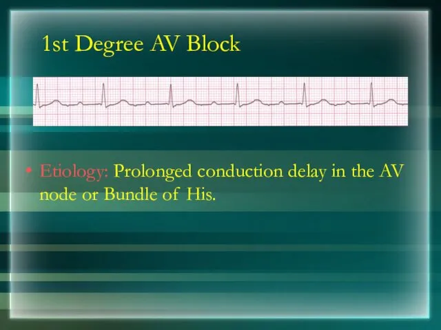 1st Degree AV Block Etiology: Prolonged conduction delay in the AV node or Bundle of His.