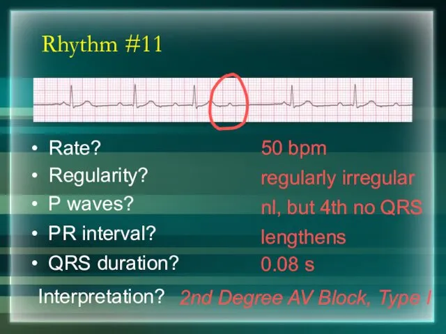 Rhythm #11 50 bpm Rate? Regularity? regularly irregular nl, but 4th no QRS