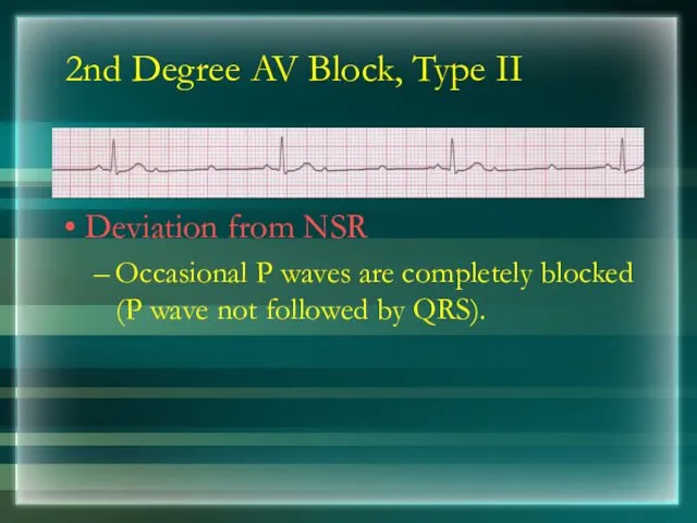 2nd Degree AV Block, Type II Deviation from NSR Occasional P waves are