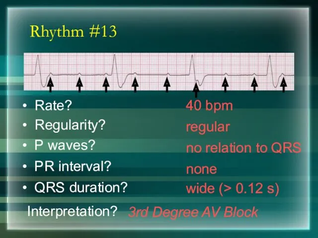 Rhythm #13 40 bpm Rate? Regularity? regular no relation to QRS wide (>