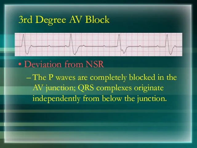 3rd Degree AV Block Deviation from NSR The P waves are completely blocked