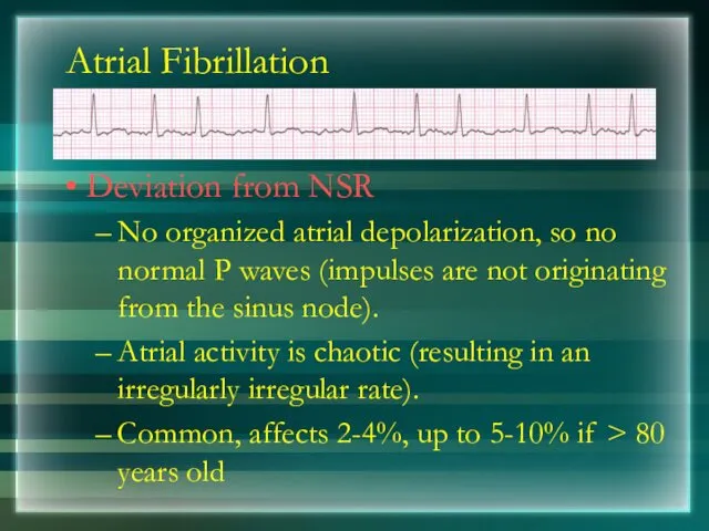 Atrial Fibrillation Deviation from NSR No organized atrial depolarization, so no normal P