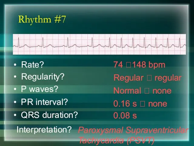 Rhythm #7 74 ?148 bpm Rate? Regularity? Regular ? regular