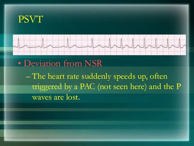 PSVT Deviation from NSR The heart rate suddenly speeds up, often triggered by