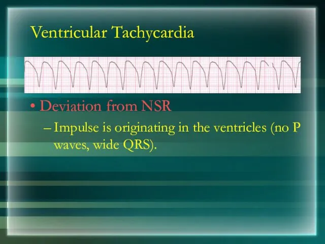 Ventricular Tachycardia Deviation from NSR Impulse is originating in the ventricles (no P waves, wide QRS).