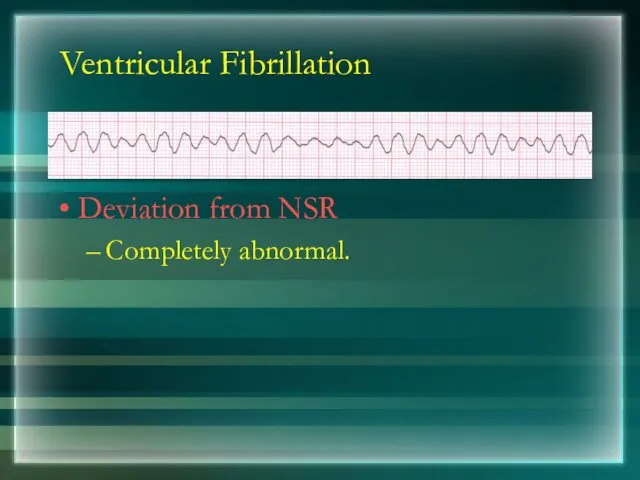Ventricular Fibrillation Deviation from NSR Completely abnormal.