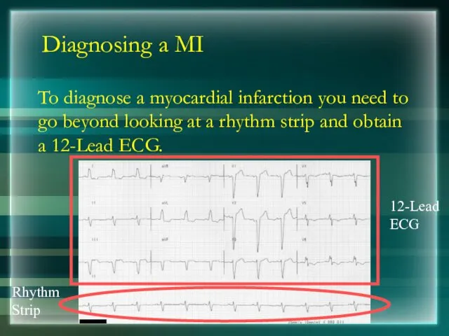 Diagnosing a MI To diagnose a myocardial infarction you need