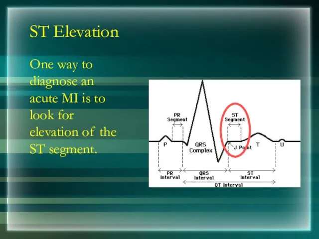 ST Elevation One way to diagnose an acute MI is to look for