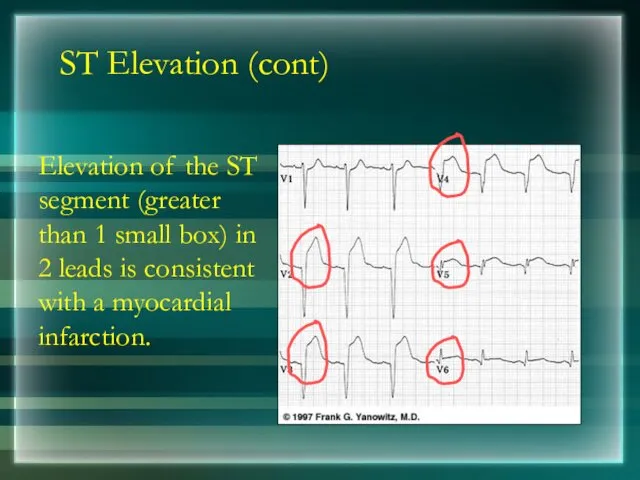 ST Elevation (cont) Elevation of the ST segment (greater than 1 small box)