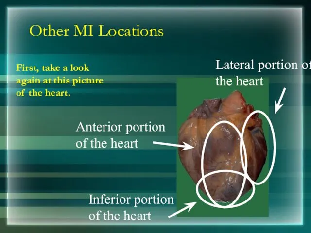 Other MI Locations First, take a look again at this picture of the heart.