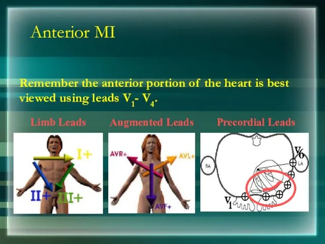 Anterior MI Remember the anterior portion of the heart is