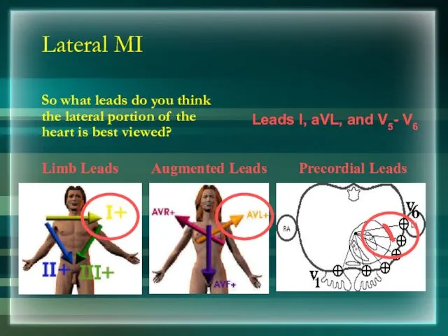 Lateral MI So what leads do you think the lateral portion of the