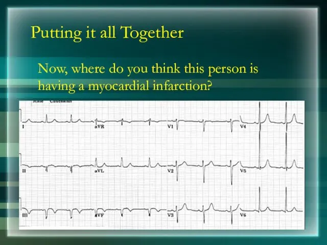 Putting it all Together Now, where do you think this person is having a myocardial infarction?