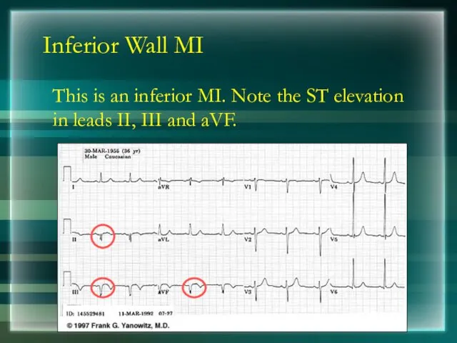 Inferior Wall MI This is an inferior MI. Note the