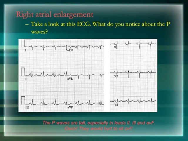 Right atrial enlargement Take a look at this ECG. What do you notice