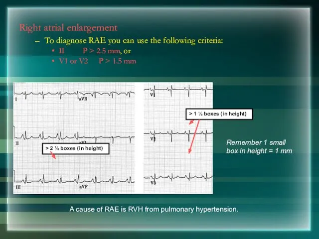 Right atrial enlargement To diagnose RAE you can use the following criteria: II