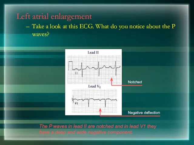 Left atrial enlargement Take a look at this ECG. What